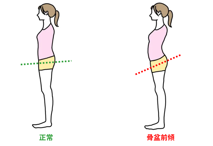 膝超伸、骨盆前傾