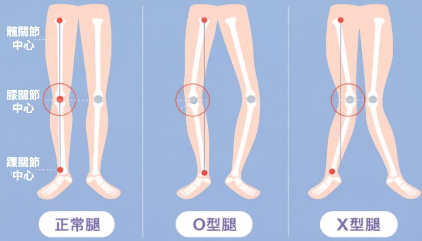 膝關節排列不佳