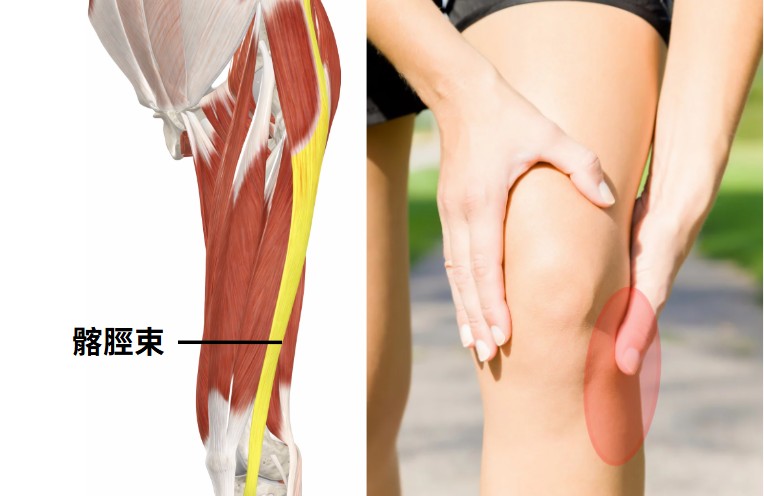 髂脛束症候群